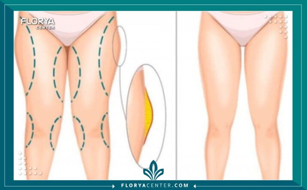 شد الجسم السفلي في تركيا 5 الصور داخل المقالة مها 81 - شد الجسم السفلي في تركيا تُعدّ عملية شد الجسم السفلي في تركيا (Lower Body Lift) واحدة من أكثر الإجراءات الجراحية التجميلية تطوراً وفعالية، وهي مصممة خصيصاً لأولئك الذين يسعون لاستعادة تناسق قوامهم، خاصة بعد فقدان الوزن الكبير أو نتيجة لآثار الشيخوخة الطبيعية. إنها ليست مجرد جراحة، بل هي رحلة نحو استعادة الثقة بالنفس والشعور بالراحة في جسدك.
