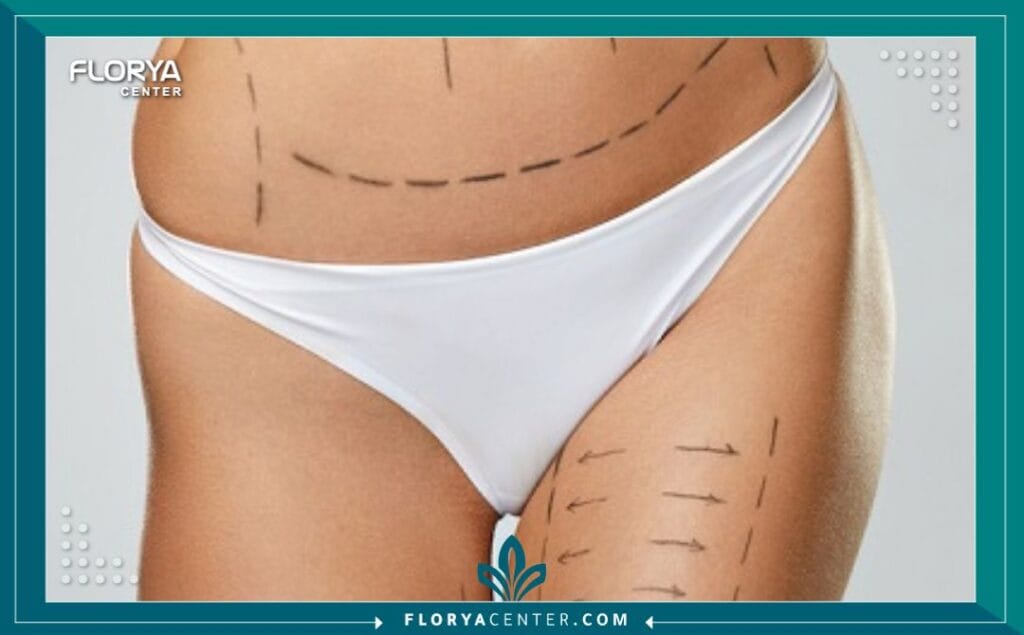 شد الجسم السفلي في تركيا 4 الصور داخل المقالة مها 83 - شد الجسم السفلي في تركيا تُعدّ عملية شد الجسم السفلي في تركيا (Lower Body Lift) واحدة من أكثر الإجراءات الجراحية التجميلية تطوراً وفعالية، وهي مصممة خصيصاً لأولئك الذين يسعون لاستعادة تناسق قوامهم، خاصة بعد فقدان الوزن الكبير أو نتيجة لآثار الشيخوخة الطبيعية. إنها ليست مجرد جراحة، بل هي رحلة نحو استعادة الثقة بالنفس والشعور بالراحة في جسدك.
