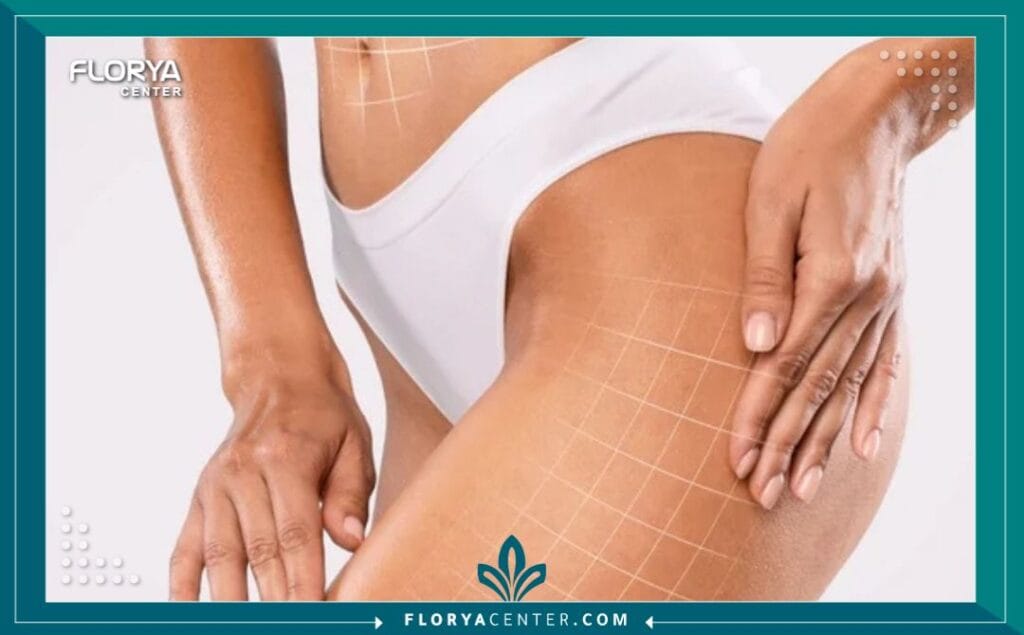 شد الجسم السفلي في تركيا 3 الصور داخل المقالة مها 84 - شد الجسم السفلي في تركيا تُعدّ عملية شد الجسم السفلي في تركيا (Lower Body Lift) واحدة من أكثر الإجراءات الجراحية التجميلية تطوراً وفعالية، وهي مصممة خصيصاً لأولئك الذين يسعون لاستعادة تناسق قوامهم، خاصة بعد فقدان الوزن الكبير أو نتيجة لآثار الشيخوخة الطبيعية. إنها ليست مجرد جراحة، بل هي رحلة نحو استعادة الثقة بالنفس والشعور بالراحة في جسدك.