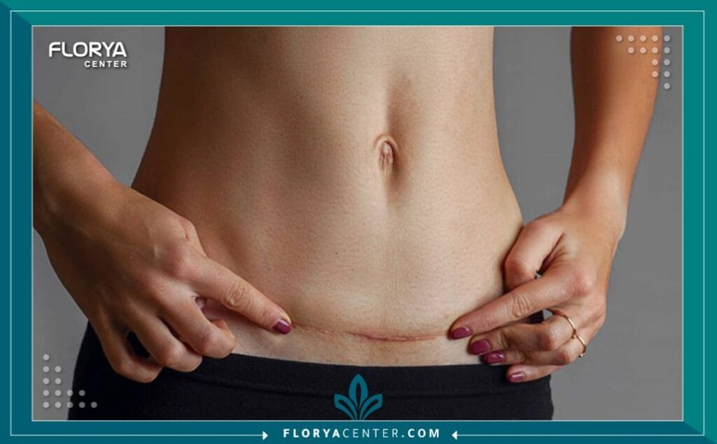 الصور داخل المقالة مها 85 - عمليات الشد الجراحية في تركيا تُعتبر عمليات الشد الجراحية في تركيا (Surgical Lift Procedures in Turkey) اليوم معياراً ذهبياً للباحثين عن استعادة الشباب وتجديد المظهر بثقة وجودة عالية. لم يعد التقدم في السن أو تأثيرات الجاذبية عائقاً دائماً أمام الحصول على مظهر مشدود وحيوي. مع التطور الهائل في التقنيات الطبية والخبرات الجراحية المتراكمة، تقدم تركيا، وتحديداً اسطنبول، حلولاً متكاملة تجمع بين الدقة الطبية الفائقة والتكاليف التنافسية. لم تعد هذه الإجراءات مجرد رفاهية، بل هي استثمار مدروس في الذات، يهدف إلى مواءمة المظهر الخارجي مع الروح الشابة في الداخل، وهو ما يبرع فيه جراحو التجميل الأتراك بفضل رؤيتهم الفنية وخبرتهم العميقة.