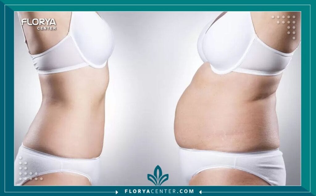 شد الترهلات بعد التكميم في تركيا 2 شد الترهلات بعد التكميم في تركيا