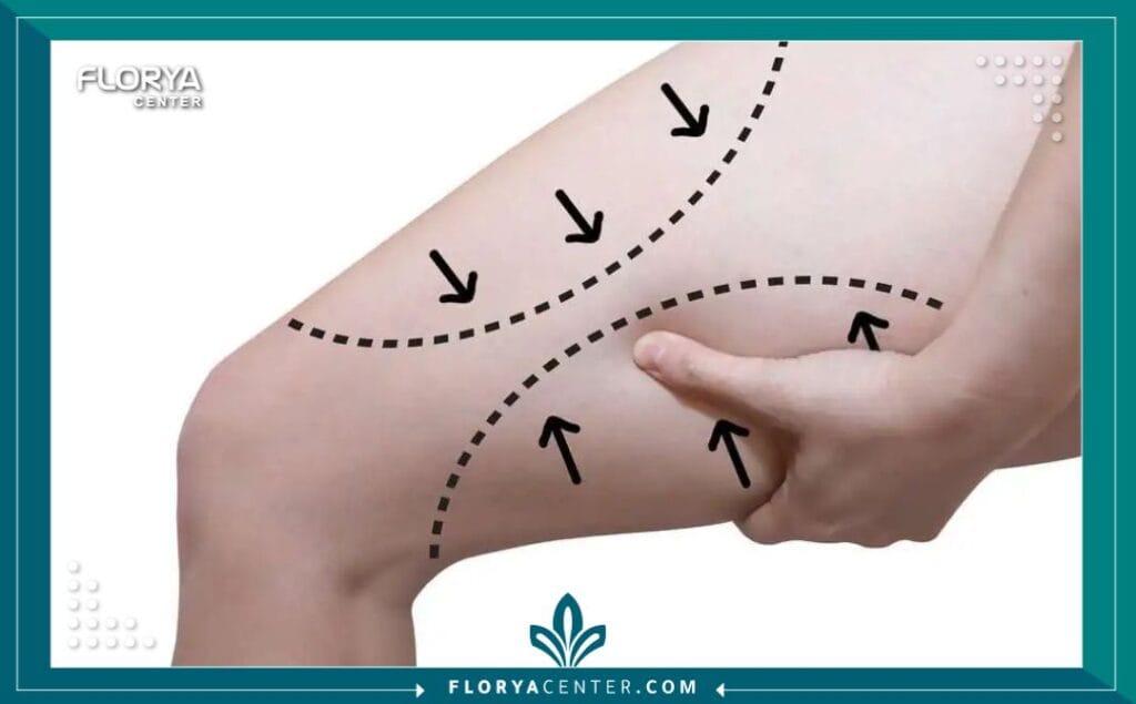 شد الترهلات بعد التكميم في تركيا 4 الصور داخل المقالة مها 93 - شد الترهلات بعد التكميم في تركيا يمثل إجراء شد الترهلات بعد التكميم في تركيا نقطة تحول حاسمة في رحلة استعادة الثقة والمظهر المتناسق بعد فقدان الوزن الهائل. إن قرار الخضوع لجراحة تكميم المعدة هو انتصار صحي كبير، لكنه غالباً ما يترك خلفه جلداً زائداً وترهلات عنيدة لا تستجيب للرياضة أو النظام الغذائي. هنا يأتي دور جراحة نحت الجسم بعد جراحات السمنة (Post-Bariatric Body Contouring)، وهي ليست مجرد إجراء تجميلي، بل هي خطوة ضرورية لاستكمال النجاح الذي بدأته، حيث تمنحك الفرصة للاستمتاع بجسد مشدود يعكس الإنجاز الذي حققته.