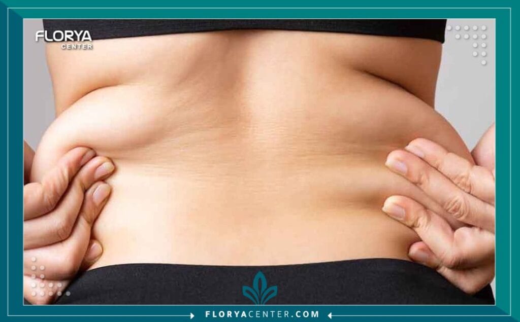 شد الترهلات بعد التكميم في تركيا 5 الصور داخل المقالة مها 94 - شد الترهلات بعد التكميم في تركيا يمثل إجراء شد الترهلات بعد التكميم في تركيا نقطة تحول حاسمة في رحلة استعادة الثقة والمظهر المتناسق بعد فقدان الوزن الهائل. إن قرار الخضوع لجراحة تكميم المعدة هو انتصار صحي كبير، لكنه غالباً ما يترك خلفه جلداً زائداً وترهلات عنيدة لا تستجيب للرياضة أو النظام الغذائي. هنا يأتي دور جراحة نحت الجسم بعد جراحات السمنة (Post-Bariatric Body Contouring)، وهي ليست مجرد إجراء تجميلي، بل هي خطوة ضرورية لاستكمال النجاح الذي بدأته، حيث تمنحك الفرصة للاستمتاع بجسد مشدود يعكس الإنجاز الذي حققته.