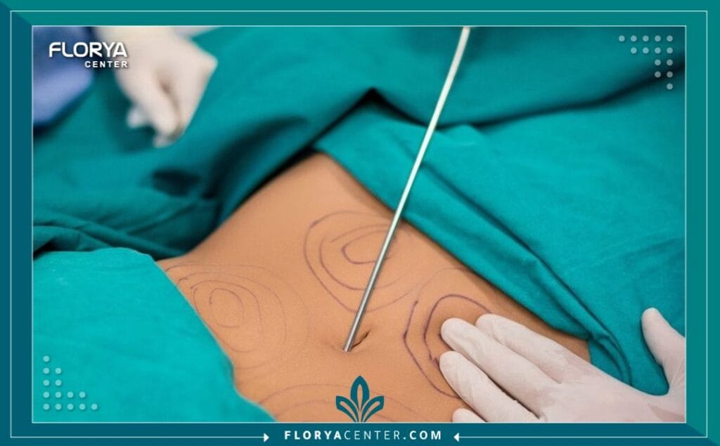 الصور داخل المقالة مها 97 - تقنيات شفط الدهون في تركيا تُعد تقنيات شفط الدهون في تركيا (Liposuction Techniques in Turkey) ثورة حقيقية في عالم الجراحة التجميلية، مقدمةً حلولاً جذرية لنحت القوام والتخلص من الدهون الموضعية العنيدة التي لا تستجيب للرياضة أو الحميات الغذائية. لم تعد اسطنبول مجرد وجهة سياحية، بل أصبحت عاصمة عالمية للجراحات التجميلية، ويأتي على رأسها إجراءات شفط الدهون بفضل التطور التكنولوجي الهائل والخبرة الطبية الفائقة. إن البحث عن قوام مثالي ومتناسق هو رحلة تبدأ بالمعرفة، واختيار تقنيات شفط الدهون في تركيا هو الخطوة الأولى نحو تحقيق هذا الهدف بثقة وأمان.