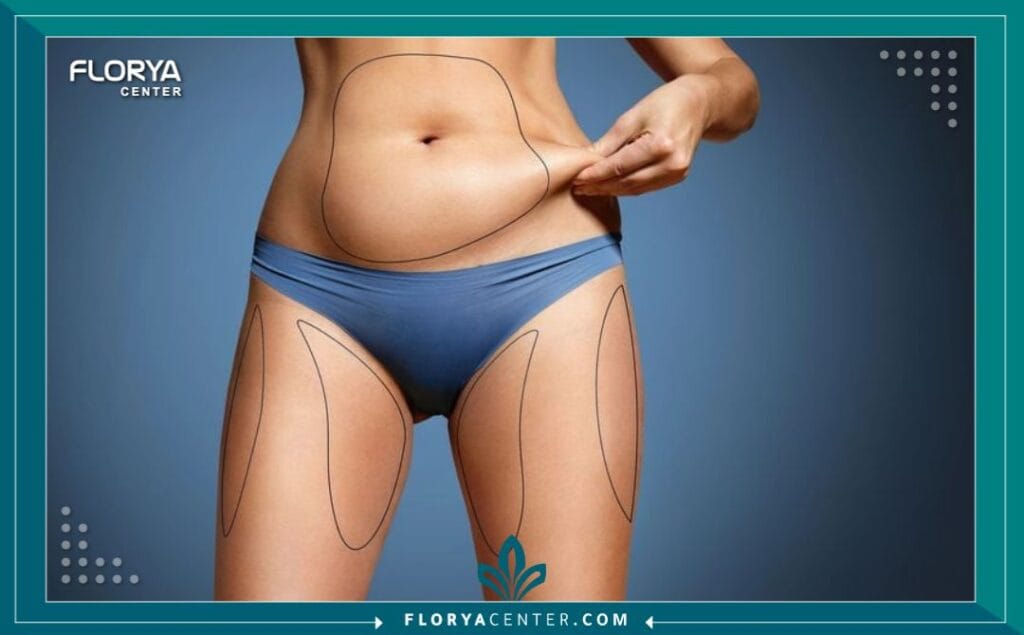 تقنيات شفط الدهون في تركيا