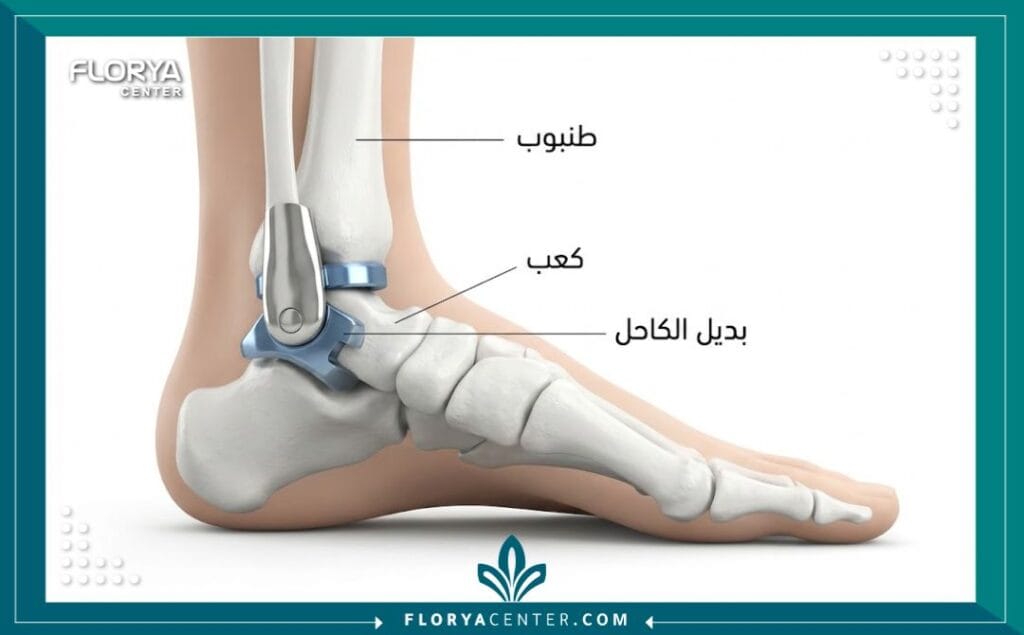 رسم توضيحي لتكوين مفصل الكاحل الصناعي وكيفية زراعته جراحياً