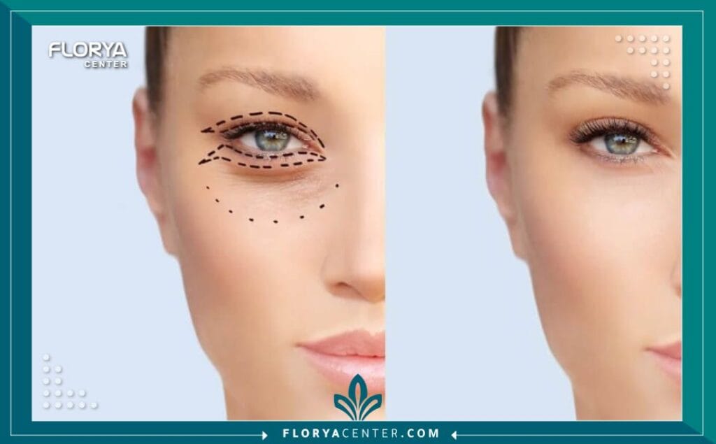 تكلفة تجميل العيون في تركيا 2 تكلفة تجميل العيون في تركيا
