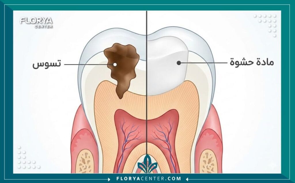 حشوات الأسنان في تركيا 2 رسم توضيحي يظهر تشريح السن والفرق بين التسوس والسن المعالج بحشوة ضوئية.