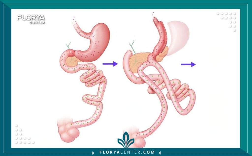 عملية الساسي في تركيا SASI Bypass 2 - عملية الساسي في تركيا تُعد عملية الساسي في تركيا اليوم ثورة في عالم جراحات السمنة، حيث تقدم حلاً مزدوجاً فعالاً ليس فقط لفقدان الوزن الزائد، بل ولعلاج الأمراض الاستقلابية، وعلى رأسها مرض السكري من النوع الثاني. يمثل هذا الإجراء المتقدم، المعروف علمياً باسم "تحويل مسار المعدة المقسّم ذو الوصلة الواحدة" (Single Anastomosis Sleeve Ileal Bypass أو SASI)، أملاً جديداً للمرضى الذين يبحثون عن نتائج مستدامة تتجاوز مجرد تصغير حجم المعدة.