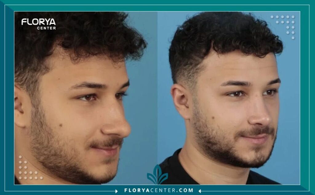 ميزات تجميل الأنف في تركيا