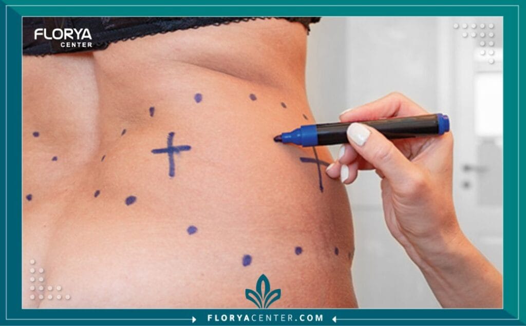 نحت الجسم بالفيزر في تركيا