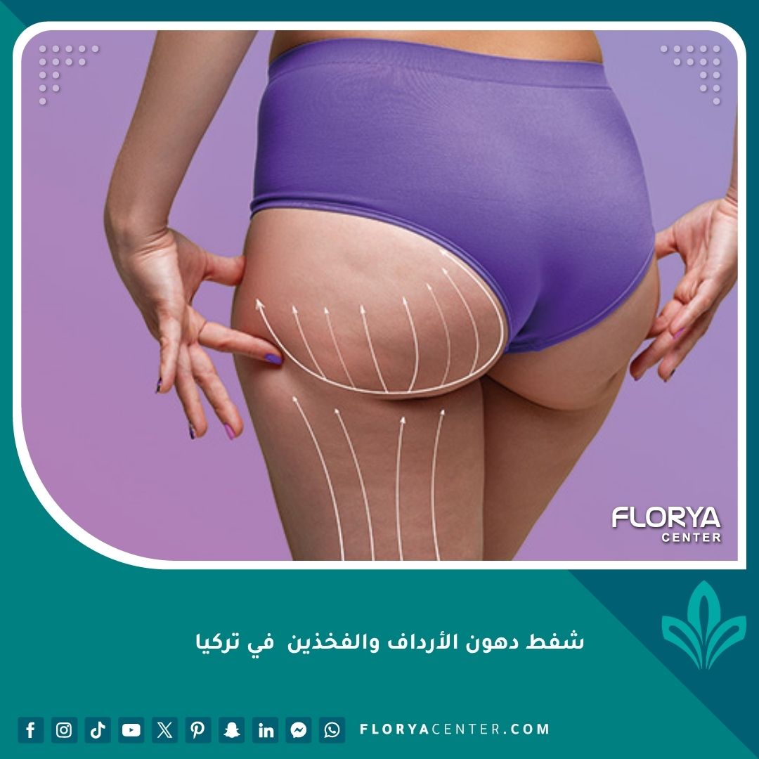 شفط دهون الأرداف والفخذين في تركيا