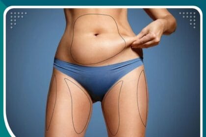 شفط الدهون التقليدي في تركيا