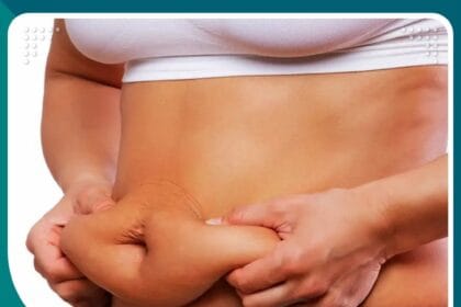 شد الترهلات بعد التكميم في تركيا