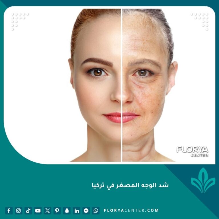 شد الوجه المصغر في تركيا