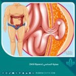 عملية الساسي (SASI Bypass)