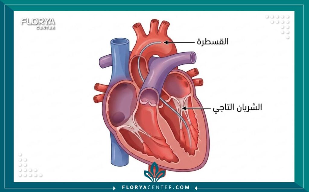 رسم توضيحي طبي يشرح كيفية إجراء عملية قسطرة القلب وتوسيع الشرايين.