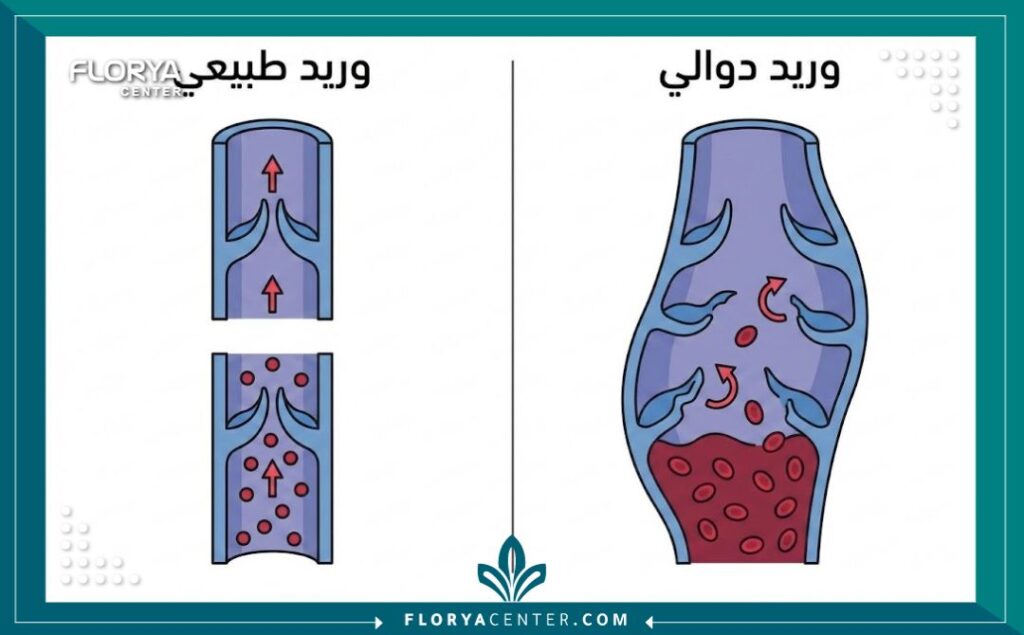 رسم تخطيطي يوضح الفرق بين الأوردة السليمة والدوالي وكيفية حدوثها.