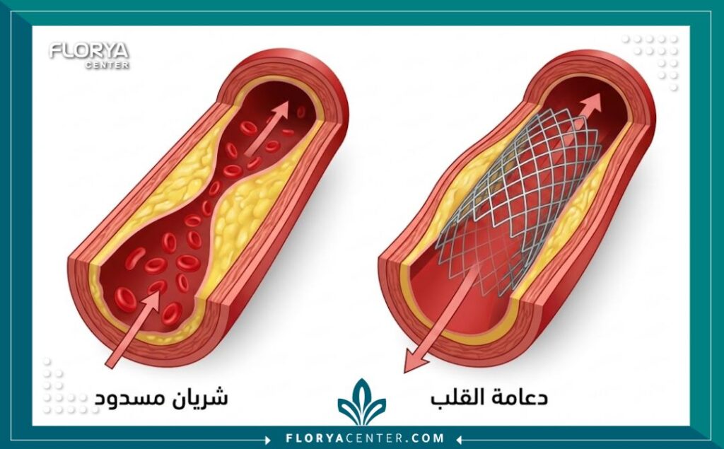أفضل نوع دعامة للقلب 2 رسم توضيحي طبي يظهر الفرق بين الشريان التاجي المسدود والشريان بعد تركيب دعامة القلب.