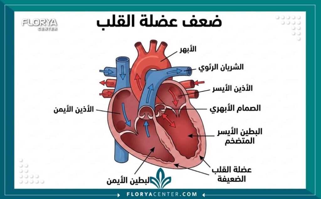 مخطط تشريحي يوضح حالة ضعف عضلة القلب وكيفية تضخم البطين.