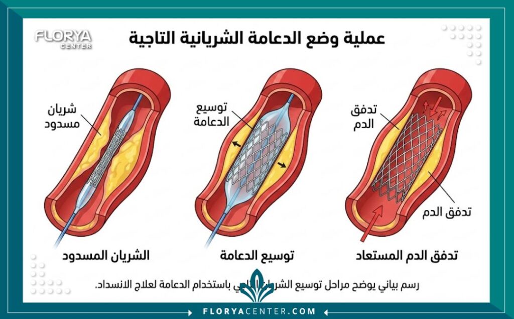 مخطط توضيحي لكيفية تركيب دعامة القلب داخل الشريان التاجي.