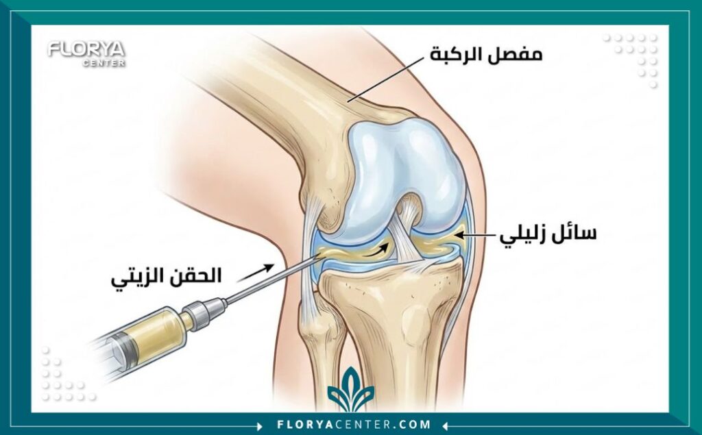 رسم توضيحي طبي يبين كيفية حقن المادة الزيتية داخل مفصل الركبة لعلاج الاحتكاك.