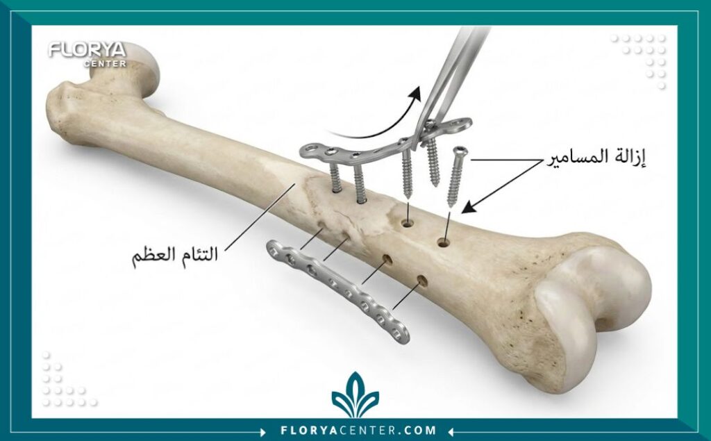 مخطط طبي يوضح كيفية إزالة الشرايح والمسامير من العظم بعد التئامه.