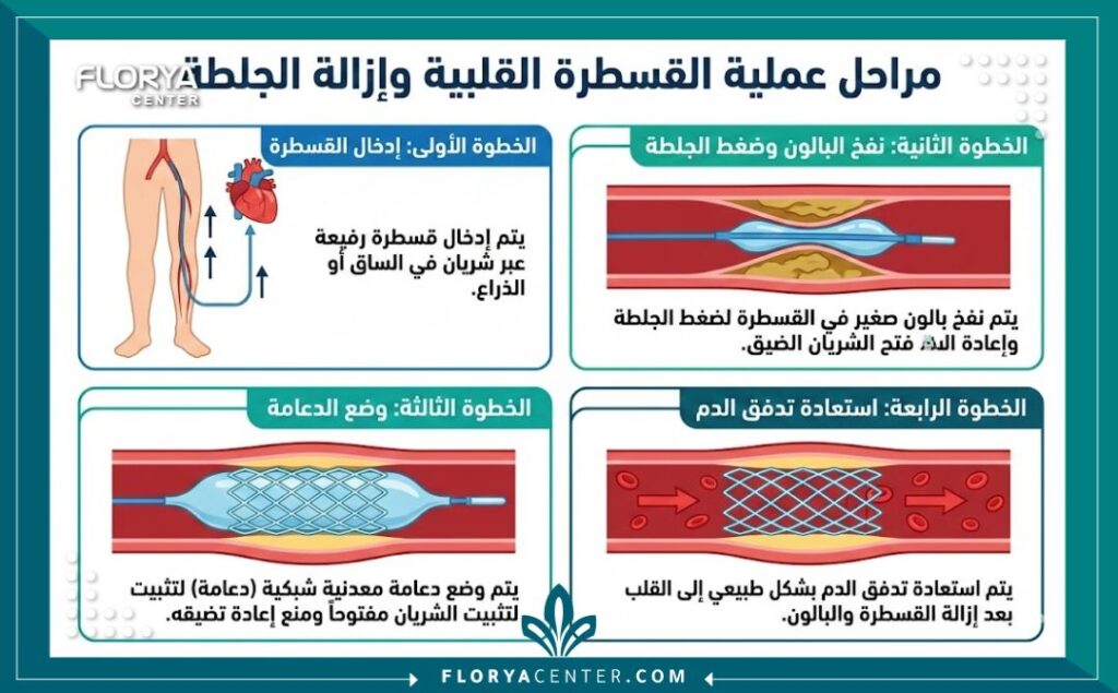 مخطط إنفوجرافيك يوضح خطوات إزالة جلطة القلب بالقسطرة بالتفصيل من إدخال الأنبوب إلى توسيع الشريان بالدعامة