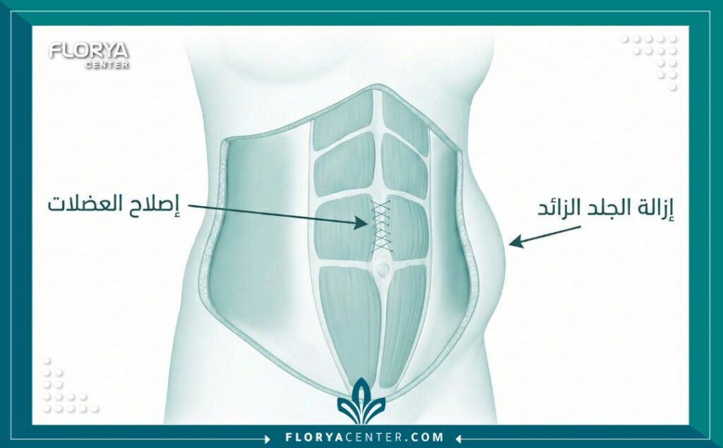 مخطط طبي يوضح تقنيات عملية شد البطن الكامل وإصلاح انفصال العضلات