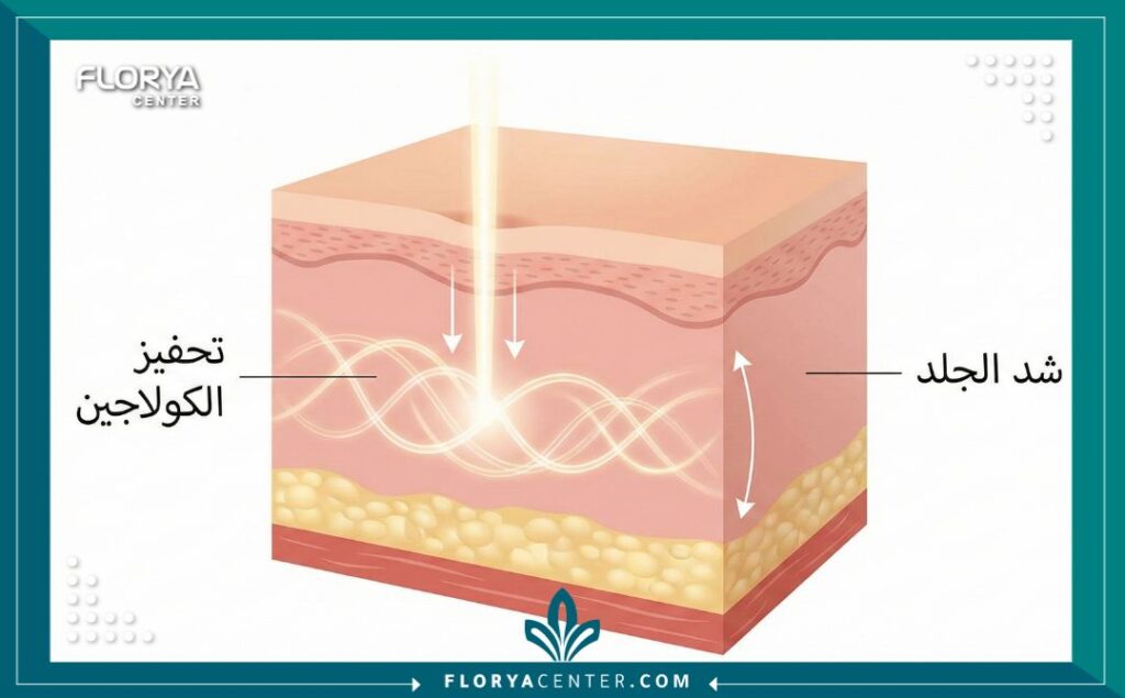 مخطط طبي يوضح كيفية عمل الليزر في تحفيز الكولاجين لشد الجلد المترهل