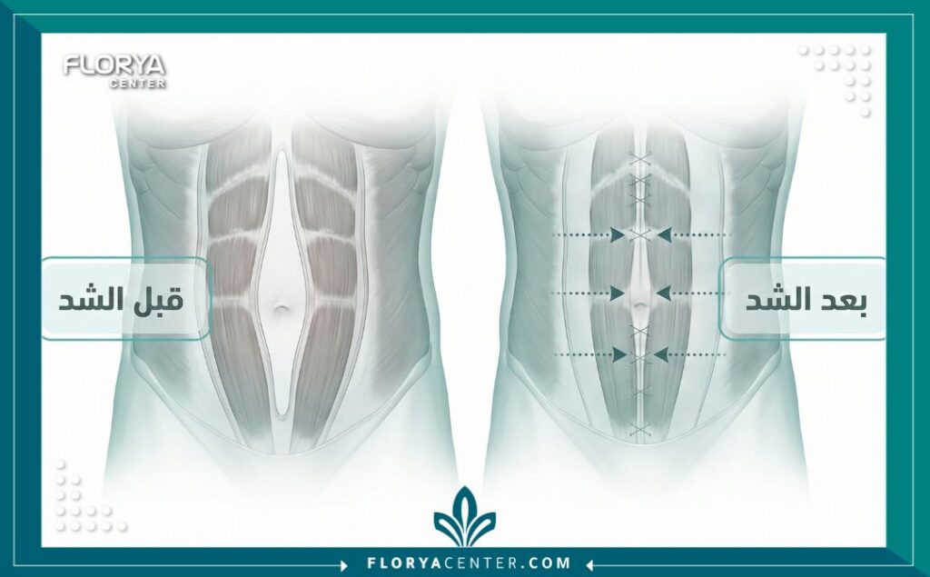 رسم توضيحي طبي يشرح عملية خياطة وشد عضلات البطن المنفصلة في عمليات التجميل