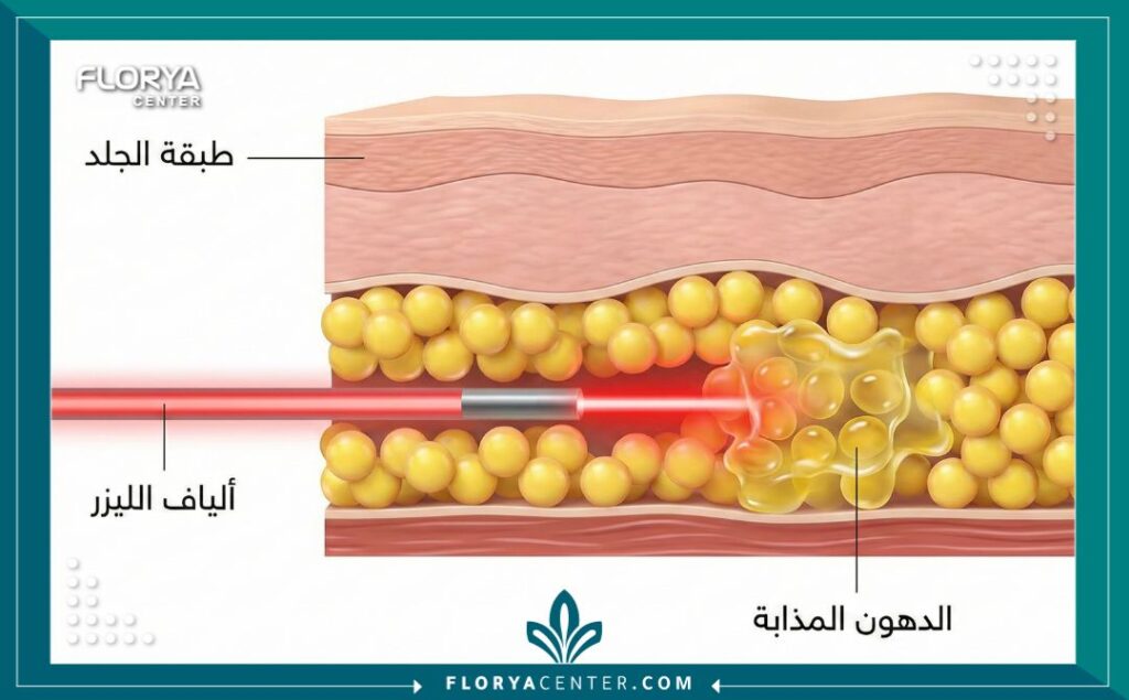 رسم توضيحي طبي يشرح كيفية إذابة الخلايا الدهنية باستخدام تقنية الليزر