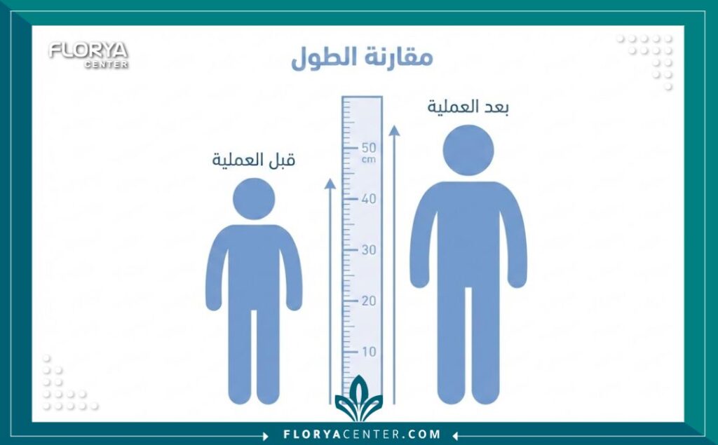 تطويل العظام في تركيا 3 إنفوجرافيك يوضح الفرق في الطول قبل وبعد إجراء عملية تطويل العظام في تركيا.