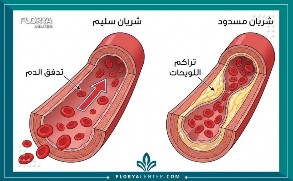 رسم توضيحي طبي يوضح الفرق بين شريان سليم وشريان مسدود، يشرح آلية أمراض الأوعية الدموية التي تتطلب التدخل الجراحي. جميع التسميات باللغة العربية لسهولة الفهم للمرضى.