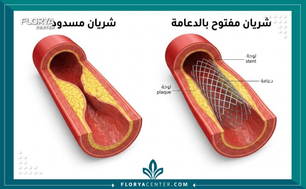 تكلفة دعامة الحياة 2 مخطط طبي يوضح الفرق بين الشريان المسدود بالجلطة والشريان بعد تركيب دعامة الحياة المنقذة.