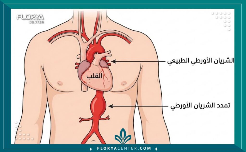 تكلفة علاج تمدد الشريان الأورطي 2 رسم توضيحي طبي يظهر الفرق بين الشريان الأورطي الطبيعي وتمدد الشريان الأورطي، مع تسميات باللغة العربية لتوضيح الحالة الطبية.