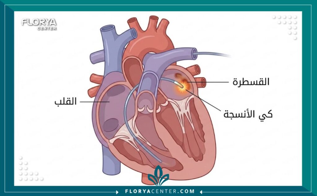رسم تخطيطي طبي يوضح كيفية إجراء عملية كي القلب بالقسطرة لعلاج اضطراب ضربات القلب.