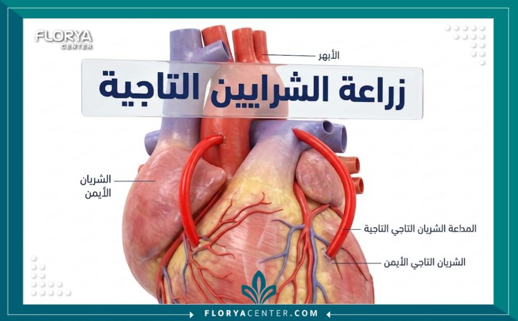 رسم تخطيطي طبي يوضح كيفية إجراء عملية زراعة الشرايين التاجية للقلب.