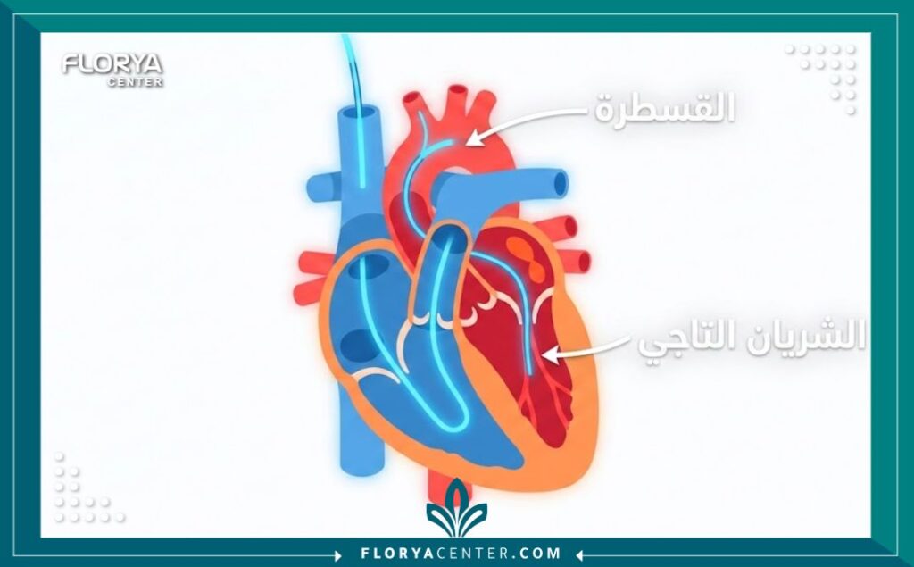 تكلفة عملية قسطرة القلب 2 مخطط طبي يوضح كيفية دخول أنبوب القسطرة إلى الشرايين التاجية للقلب.
