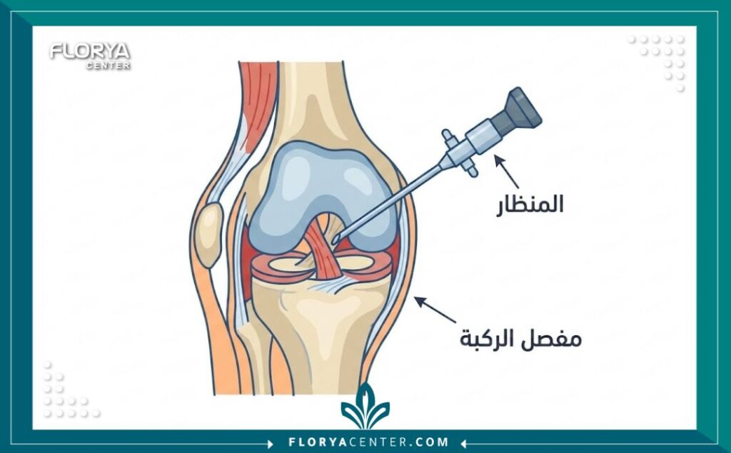 رسم توضيحي يشرح كيفية إجراء عملية منظار الركبة وتشريح المفصل.