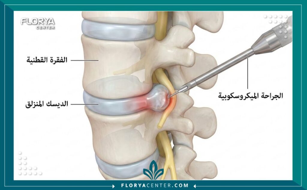 جراحة الديسك الميكروسكوبية في تركيا 2 رسم توضيحي طبي يظهر تشريح العمود الفقري وآلية استئصال الديسك بالميكروسكوب.