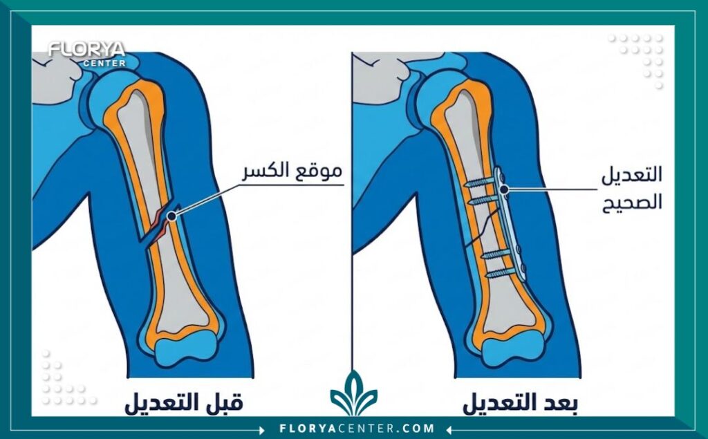 رسم توضيحي طبي يوضح كيفية محاذاة العظام المكسورة أثناء عملية التجبير.