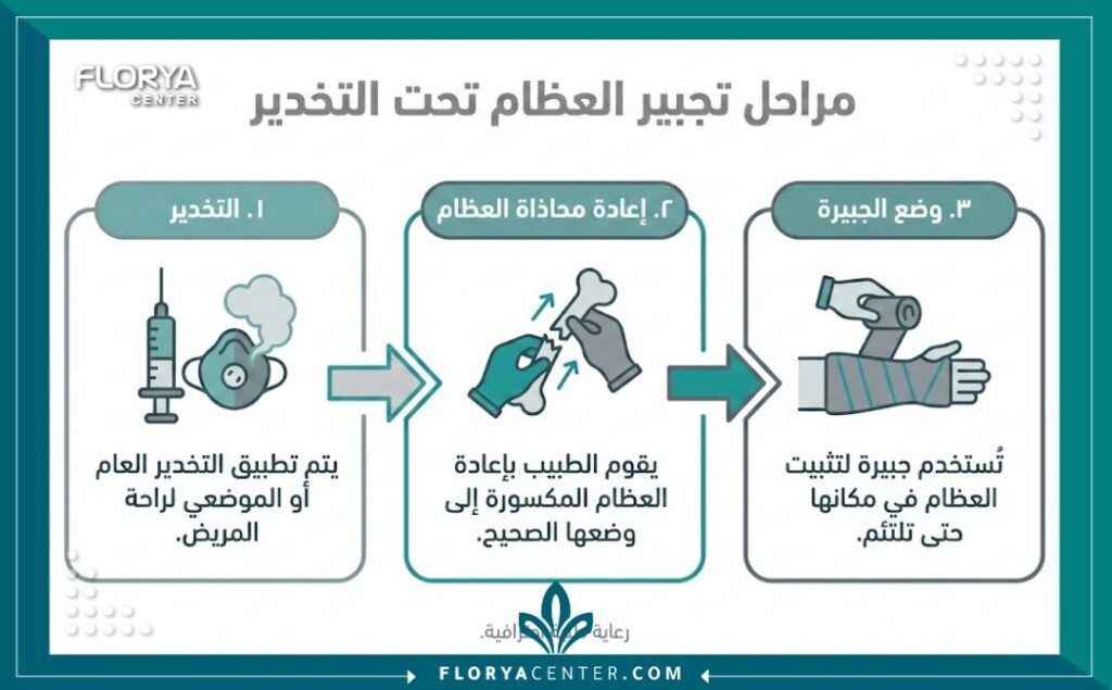 إنفوجرافيك يوضح خطوات جراحة العظم المفتوح في تركيا تحت التخدير العام.