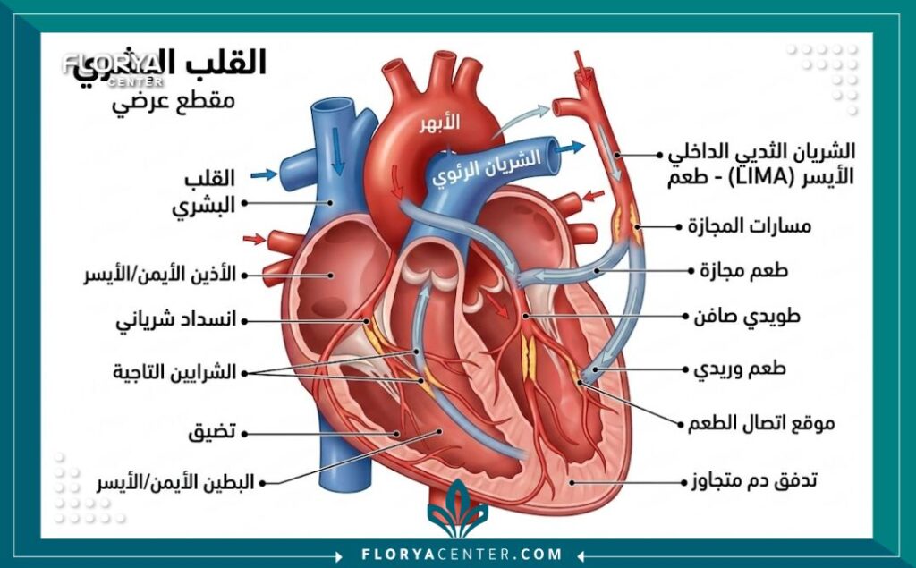 رسم توضيحي طبي يشرح تشريح القلب ومسارات الشرايين في عملية القلب المفتوح.