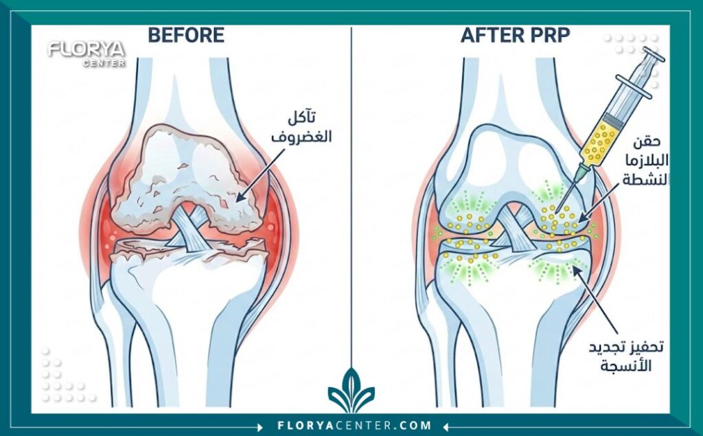 حقن البلازما للركبة (PRP) 2 رسم توضيحي طبي يظهر مقطع عرضي لمفصل الركبة، يوضح الفرق بين الركبة المصابة بالخشونة وكيفية عمل حقن البلازما (PRP) في تحفيز تجديد الغضروف والأنسجة.