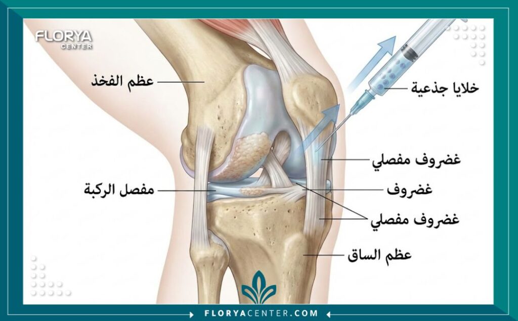 رسم توضيحي يشرح كيفية عمل الخلايا الجذعية في ترميم غضاريف المفاصل المتآكلة.