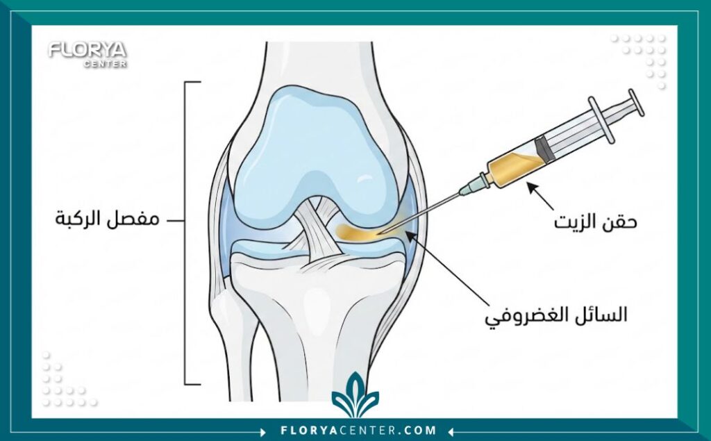 حقن الزيت للمفاصل في تركيا 2 رسم توضيحي طبي يبيّن عملية حقن الزيت داخل مفصل الركبة لعلاج الخشونة.