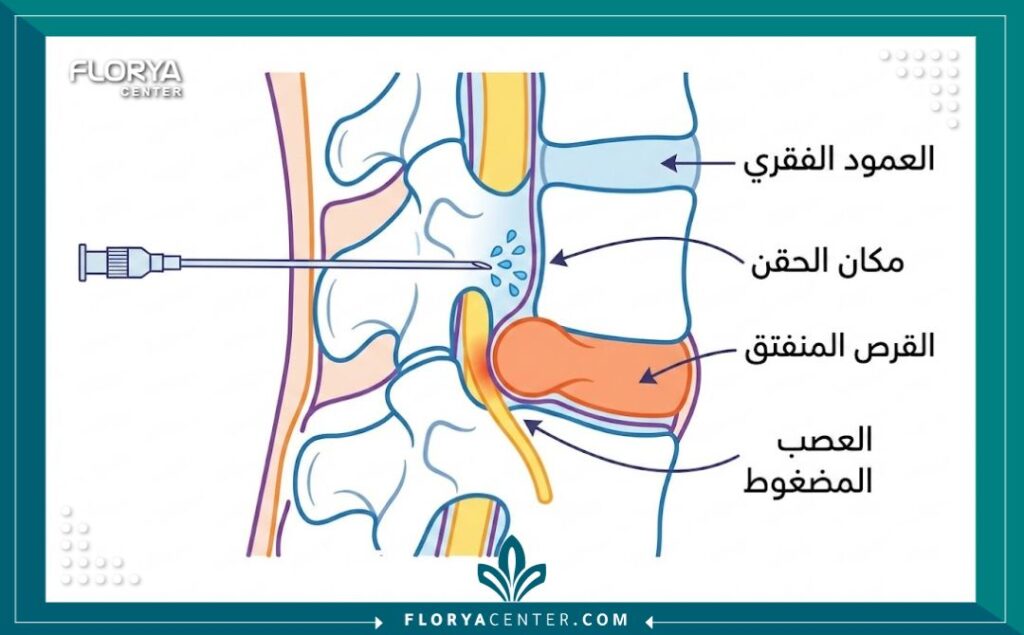رسم توضيحي طبي يظهر مقطعاً عرضياً للعمود الفقري وآلية عمل حقن الظهر لعلاج آلام الانزلاق الغضروفي، مع تسميات عربية.