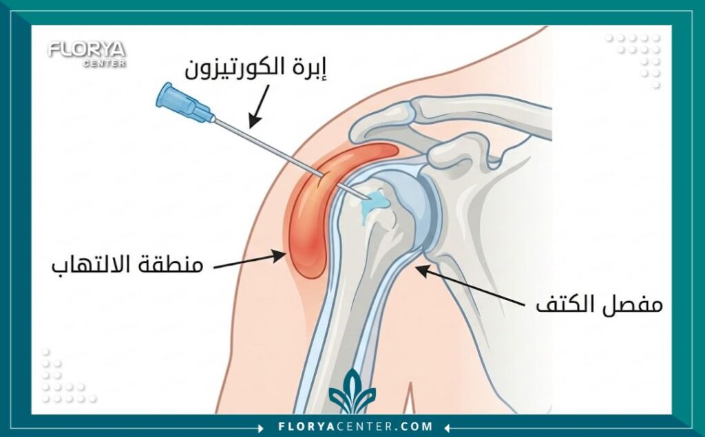 رسم توضيحي طبي يظهر تشريح مفصل الكتف ومكان حقن إبرة الكورتيزون الموضعي لعلاج الالتهاب والألم.