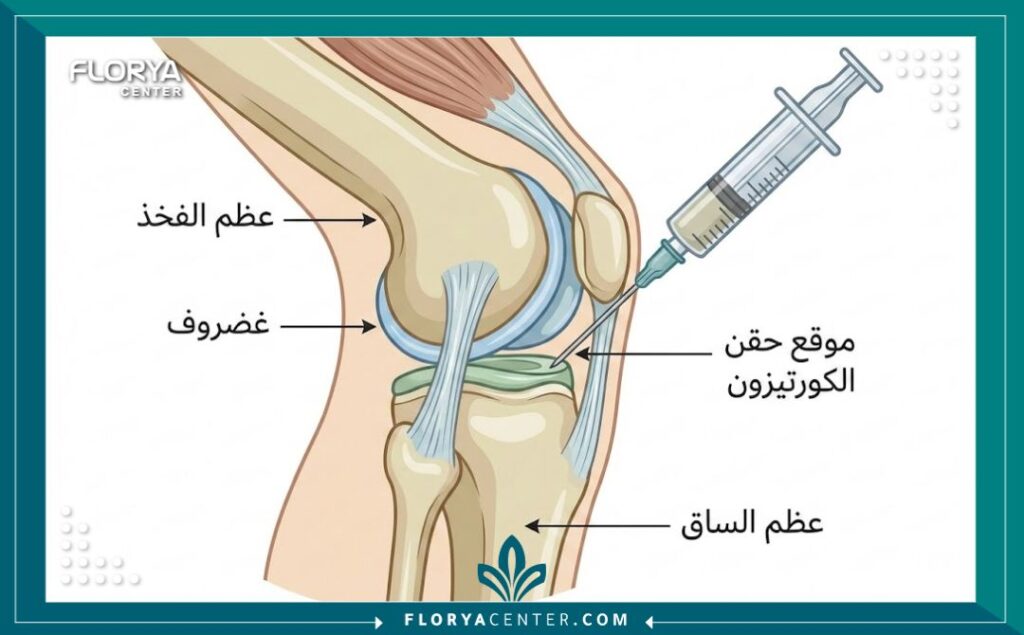 رسم توضيحي طبي مفصل لمفصل الركبة، يوضح موقع حقن الكورتيزون للعظام، مع تسميات عربية.